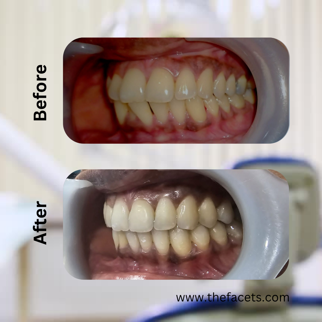 Before After 6
